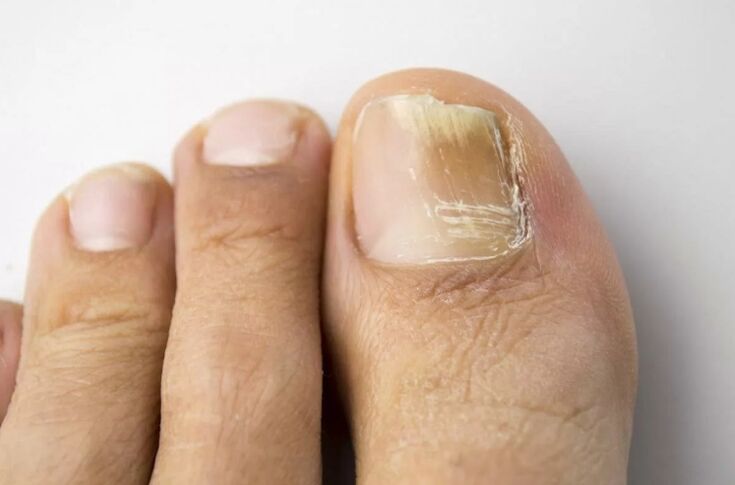 Mycose des ongles de jambe